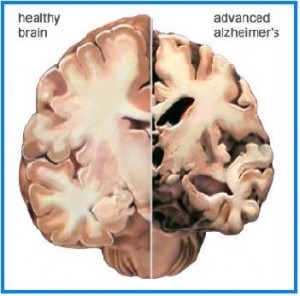Óleo de Peixe - Cérebro Normal e com Alzheimer Avançada