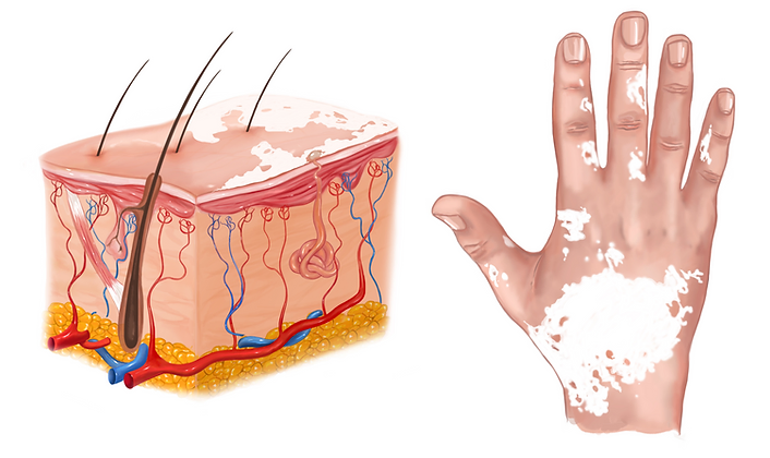 Vitiligo